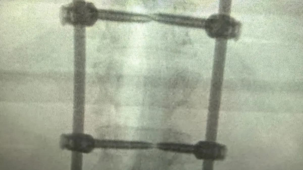 X-ray showing the rods and six screws stabilizing Chris's spine